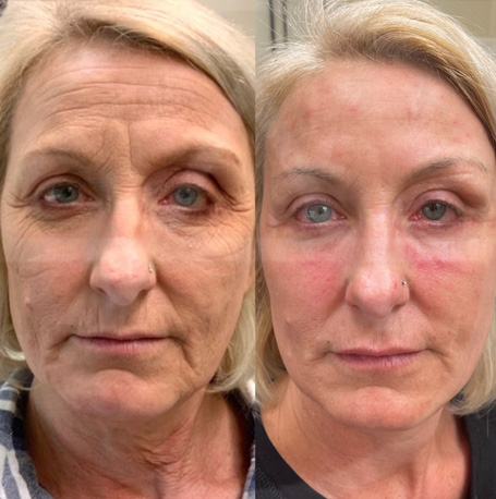 Laser resurfacing before and after images