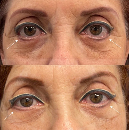 Eyelid Revision Surgery before and after images