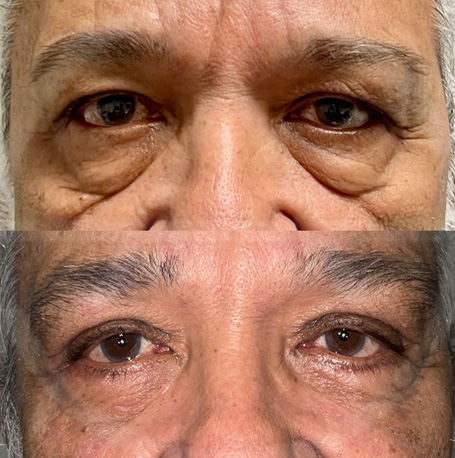 Lower Blepharoplasty before and after images