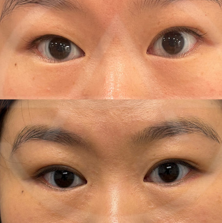 Asian eyelid before and after images