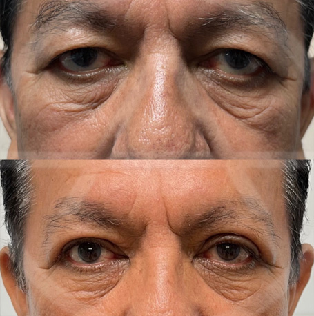 Male Blepharoplasty before and after images