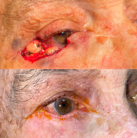 Mohs Reconstruction before and after images