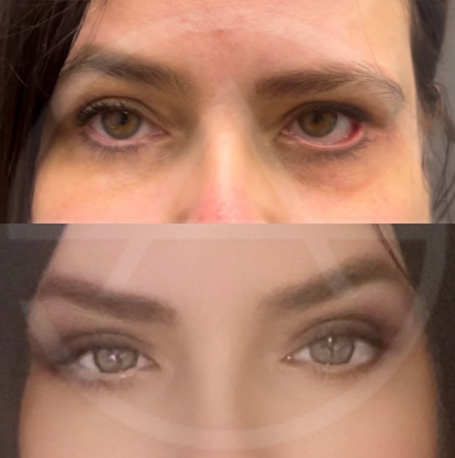Eyelid Revision Surgery before and after images