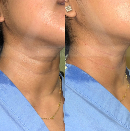 Dermal Fillers before and after images
