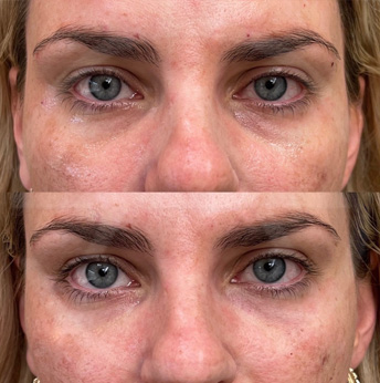 Under Eye Bags Removal before and after images