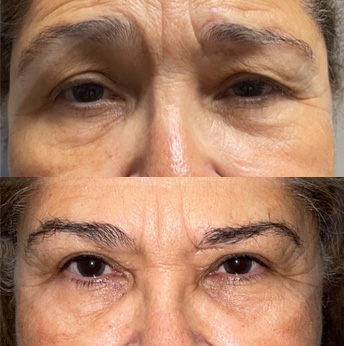 Brow Lift before and after images