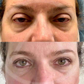 Ptosis before and after images