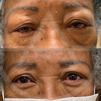 Ptosis before and after images
