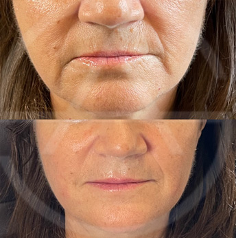 Dermal Fillers before and after images