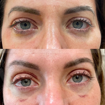 Brow Lift before and after images