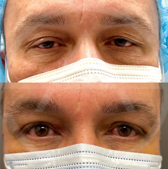 Male Blepharoplasty before and after images