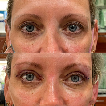 Upper eyelid before and after images