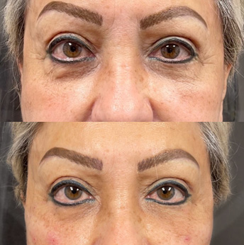 Under Eye Bags Removal before and after images