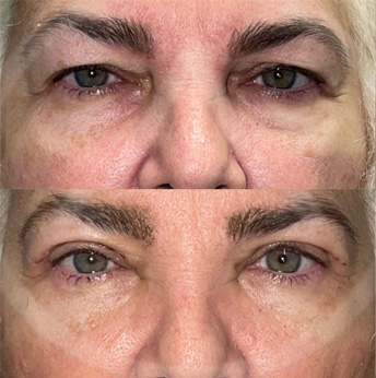 Upper eyelid before and after images