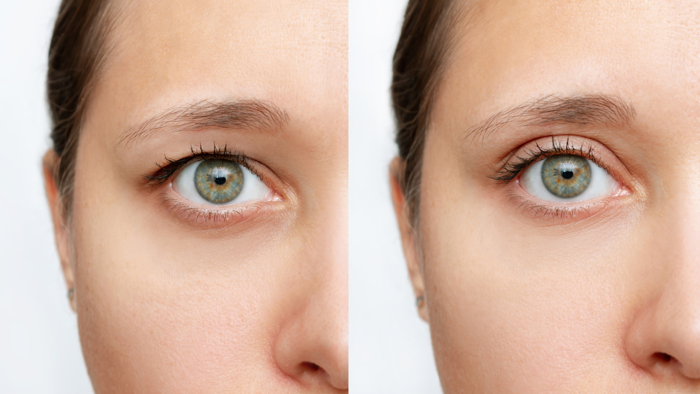 Featured image for What Does Ptosis Repair Surgery Entail is a close up of a person's face before and after blepharoplasty