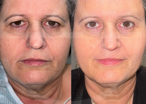 Before and after image of brow lift procedure