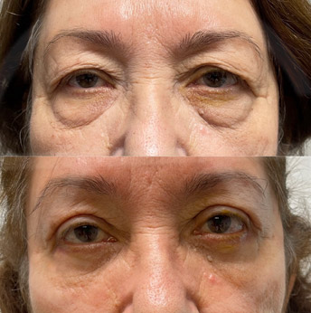 Lower Blepharoplasty before and after images