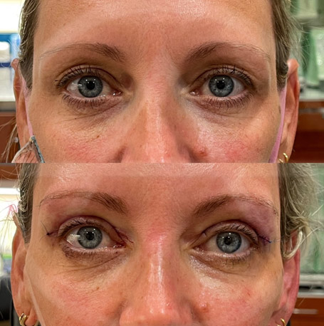 Upper eyelid before and after images